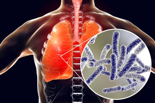 Illustration of legionella bacteria in human lungs